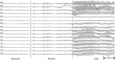 Temporal and spatial dynamic propagation of electroencephalogram by combining power spectral and synchronization in childhood absence epilepsy